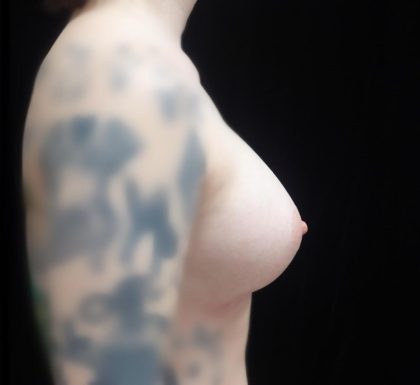 Breast Augmentation (Fat Transfer) Before & After Patient #24774