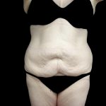 Buttock Augmentation Before & After Patient #24775