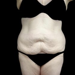 Buttock Augmentation Before & After Patient #24775