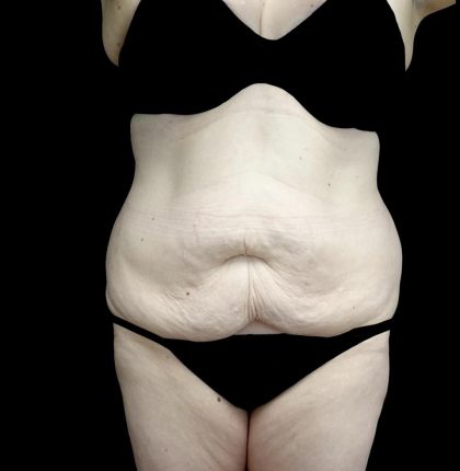 Buttock Augmentation Before & After Patient #24775