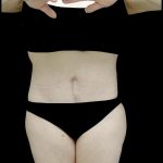 Buttock Augmentation Before & After Patient #24775