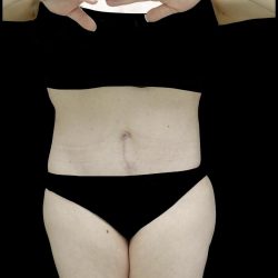 Buttock Augmentation Before & After Patient #24775