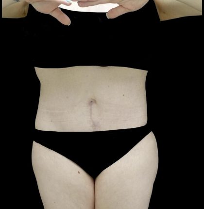 Buttock Augmentation Before & After Patient #24775