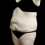 Buttock Augmentation Before & After Patient #24775