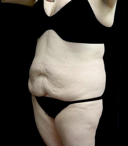 Buttock Augmentation Before & After Patient #24775