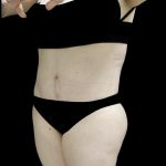 Buttock Augmentation Before & After Patient #24775