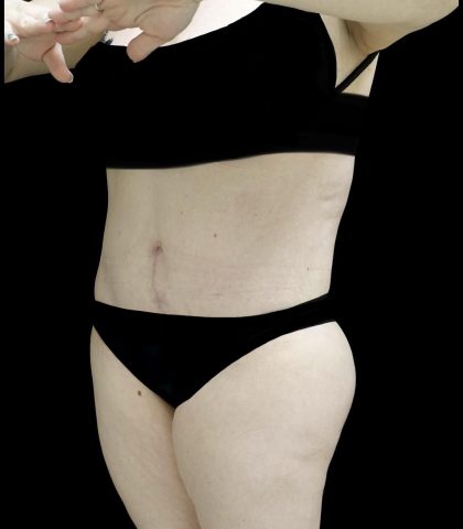 Buttock Augmentation Before & After Patient #24775