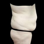 Buttock Augmentation Before & After Patient #24775