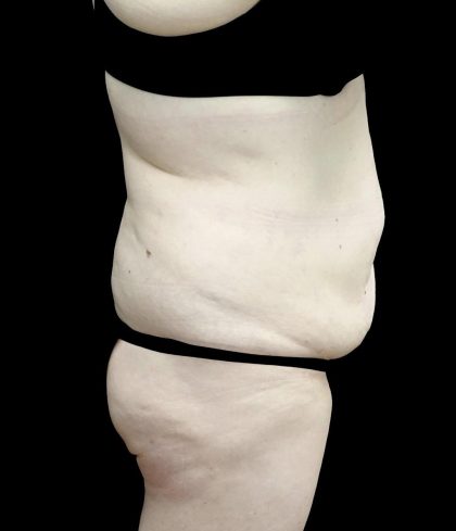 Buttock Augmentation Before & After Patient #24775
