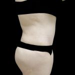 Buttock Augmentation Before & After Patient #24775