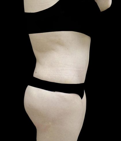 Buttock Augmentation Before & After Patient #24775