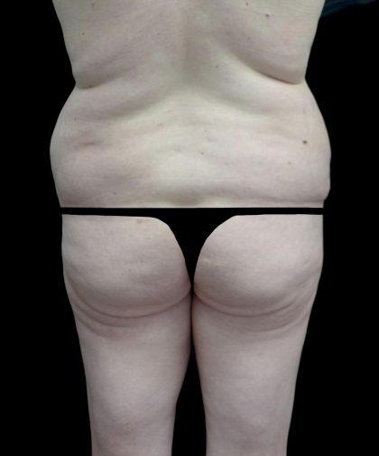 Buttock Augmentation Before & After Patient #24775