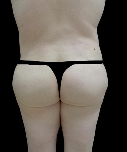 Buttock Augmentation Before & After Patient #24775