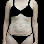Lipoabdominoplasty Before & After Patient #24776