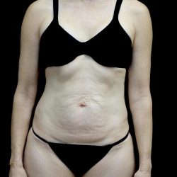Lipoabdominoplasty Before & After Patient #24776