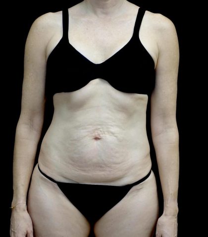 Lipoabdominoplasty Before & After Patient #24776
