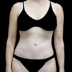 Lipoabdominoplasty Before & After Patient #24776