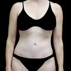 Lipoabdominoplasty Before & After Patient #24776