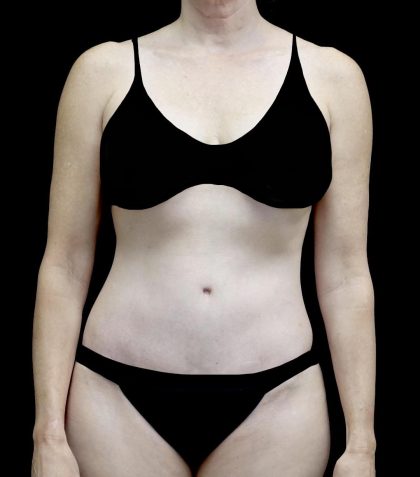 Lipoabdominoplasty Before & After Patient #24776