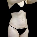 Lipoabdominoplasty Before & After Patient #24776