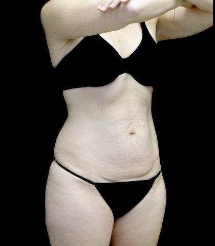 Lipoabdominoplasty Before & After Patient #24776