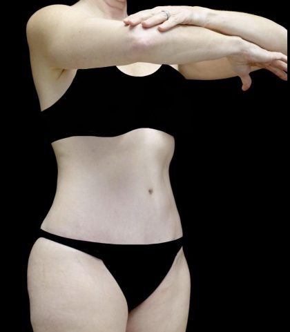 Lipoabdominoplasty Before & After Patient #24776
