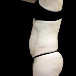 Lipoabdominoplasty Before & After Patient #24776