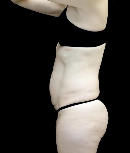 Lipoabdominoplasty Before & After Patient #24776