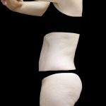 Lipoabdominoplasty Before & After Patient #24776
