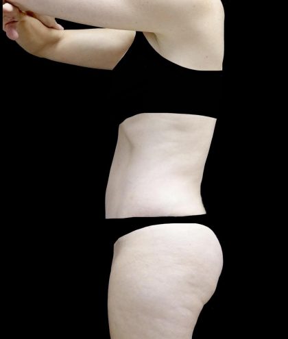 Lipoabdominoplasty Before & After Patient #24776