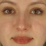 Microneedling Before & After Patient #24885