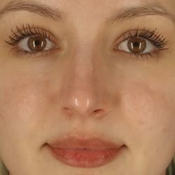 Microneedling Before & After Patient #24885