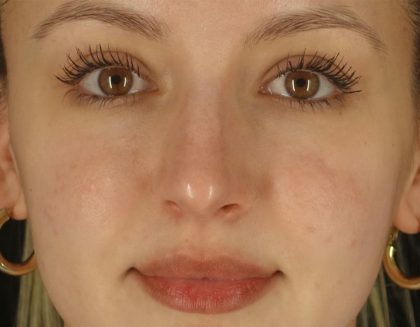 Microneedling Before & After Patient #24885
