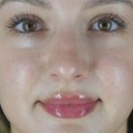 Microneedling Before & After Patient #24885