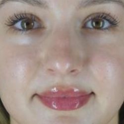 Microneedling Before & After Patient #24885