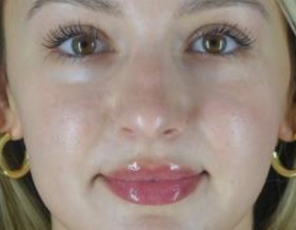Microneedling Before & After Patient #24885