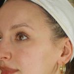 Microneedling Before & After Patient #24885