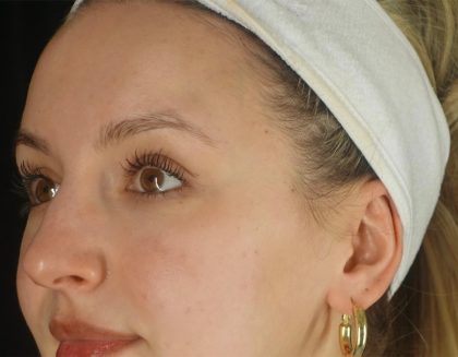 Microneedling Before & After Patient #24885