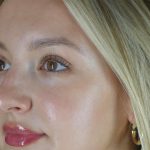 Microneedling Before & After Patient #24885