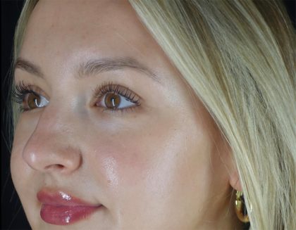 Microneedling Before & After Patient #24885