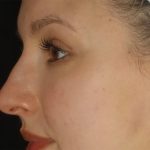 Microneedling Before & After Patient #24885