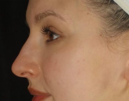 Microneedling Before & After Patient #24885