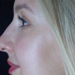 Microneedling Before & After Patient #24885