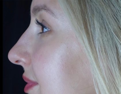 Microneedling Before & After Patient #24885