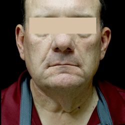 Facelift & Necklift Before & After Patient #24963