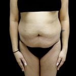 Liposuction Before & After Patient #24973