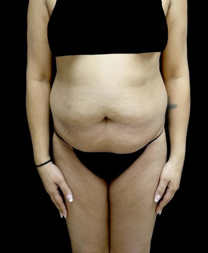 Liposuction Before & After Patient #24973