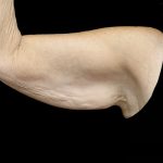 Brachioplasty Before & After Patient #24987