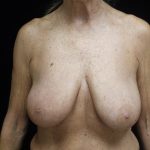 Breast Reduction Before & After Patient #24997