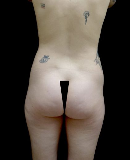Buttock Augmentation Before & After Patient #24959